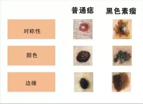 陰莖長痣|生殖部位長痣正常嗎？需要頻繁就醫嗎？